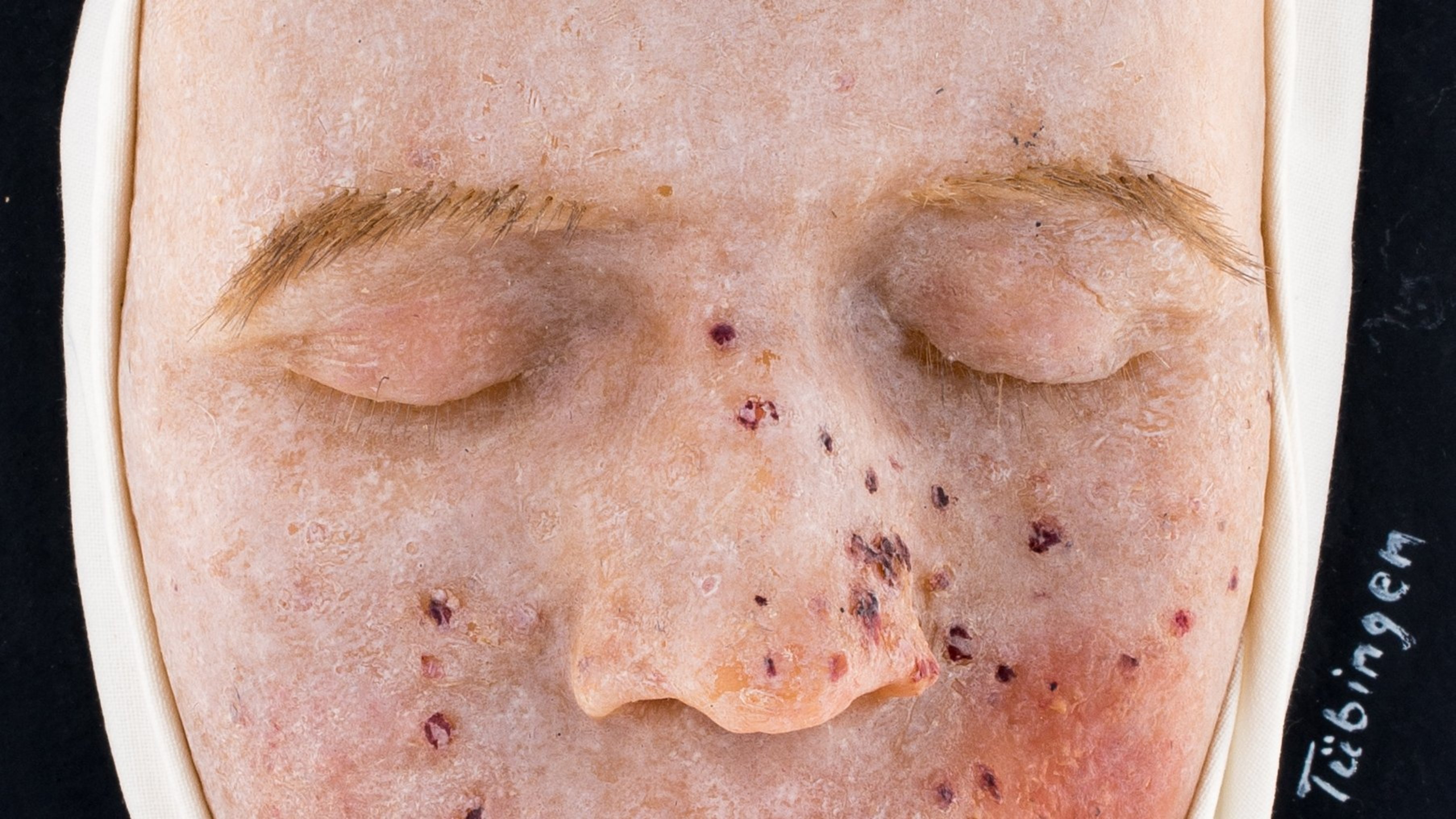 Wax replica of a patient with prurigo hebra, a skin affection that affects children at the end of the first and second year of life