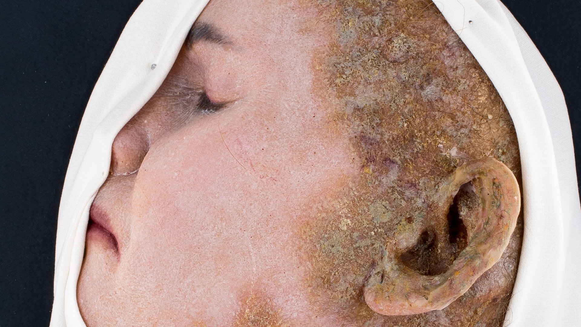 Parasitic eczema, made by: Alfons Kröner