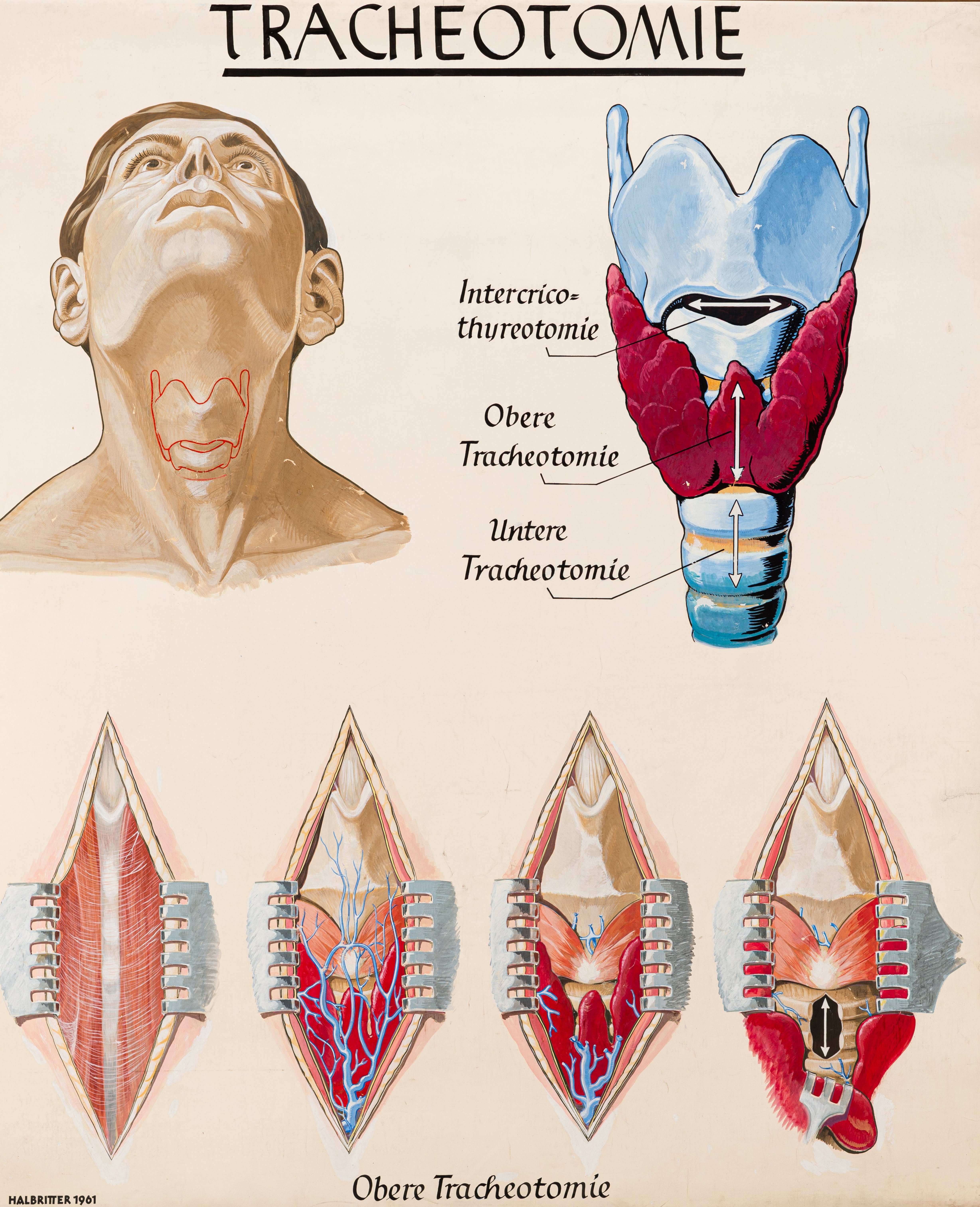 Pictorial representation of a tracheotomy