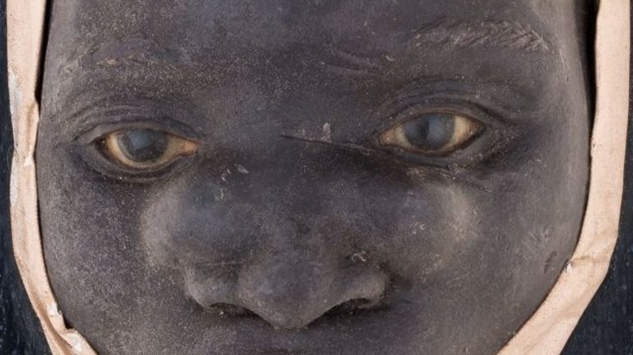 Wax replica of a patient with a tumor shape that forms symmetrically on both sides of the nose and is called gundu in various African languag